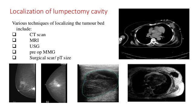 how long between lumpectomy and radiation