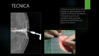Galactografia PPT