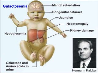 Galactosemia
 