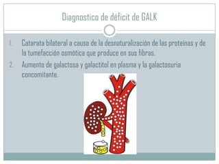 Diagnostico de déficit de GALK
1.
2.

Catarata bilateral a causa de la desnaturalización de las proteínas y de
la tumefacción osmótica que produce en sus fibras.
Aumento de galactosa y galactitol en plasma y la galactosuria
concomitante.

 