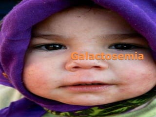 Galactosemia
 