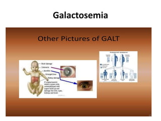 Galactosemia
15
 