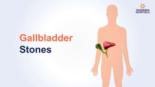 Gallbladder
Stones
 
