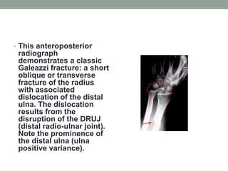 This anteroposterior radiograph demonstrates a classic Galeazzi fracture: a short oblique or transverse fracture of the radius with associated dislocation of the distal ulna. The dislocation results from the disruption of the DRUJ (distal radio-ulnar joint). Note the prominence of the distal ulna (ulna positive variance).