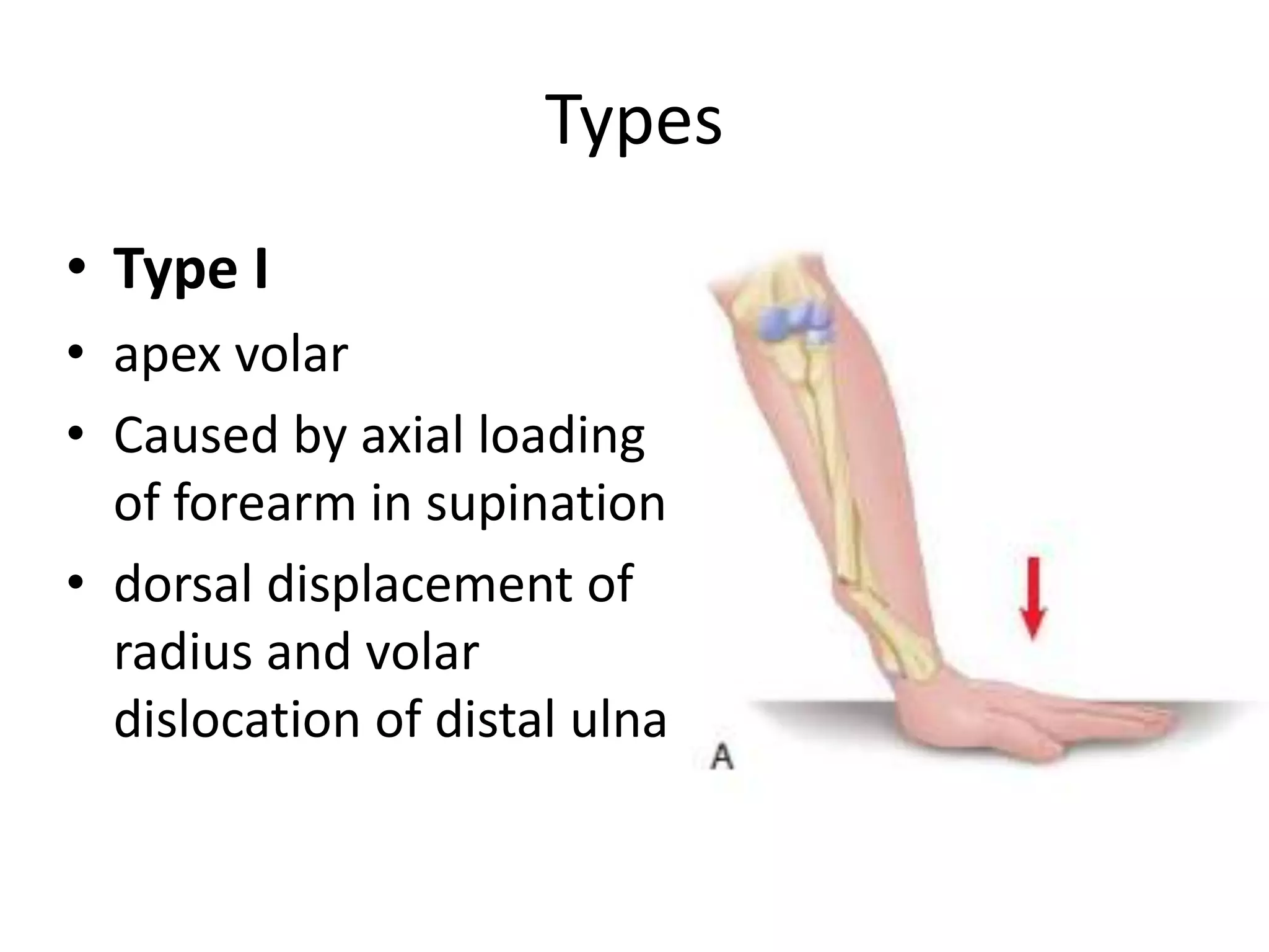 Galeazzi fracture dislocation | PPTX