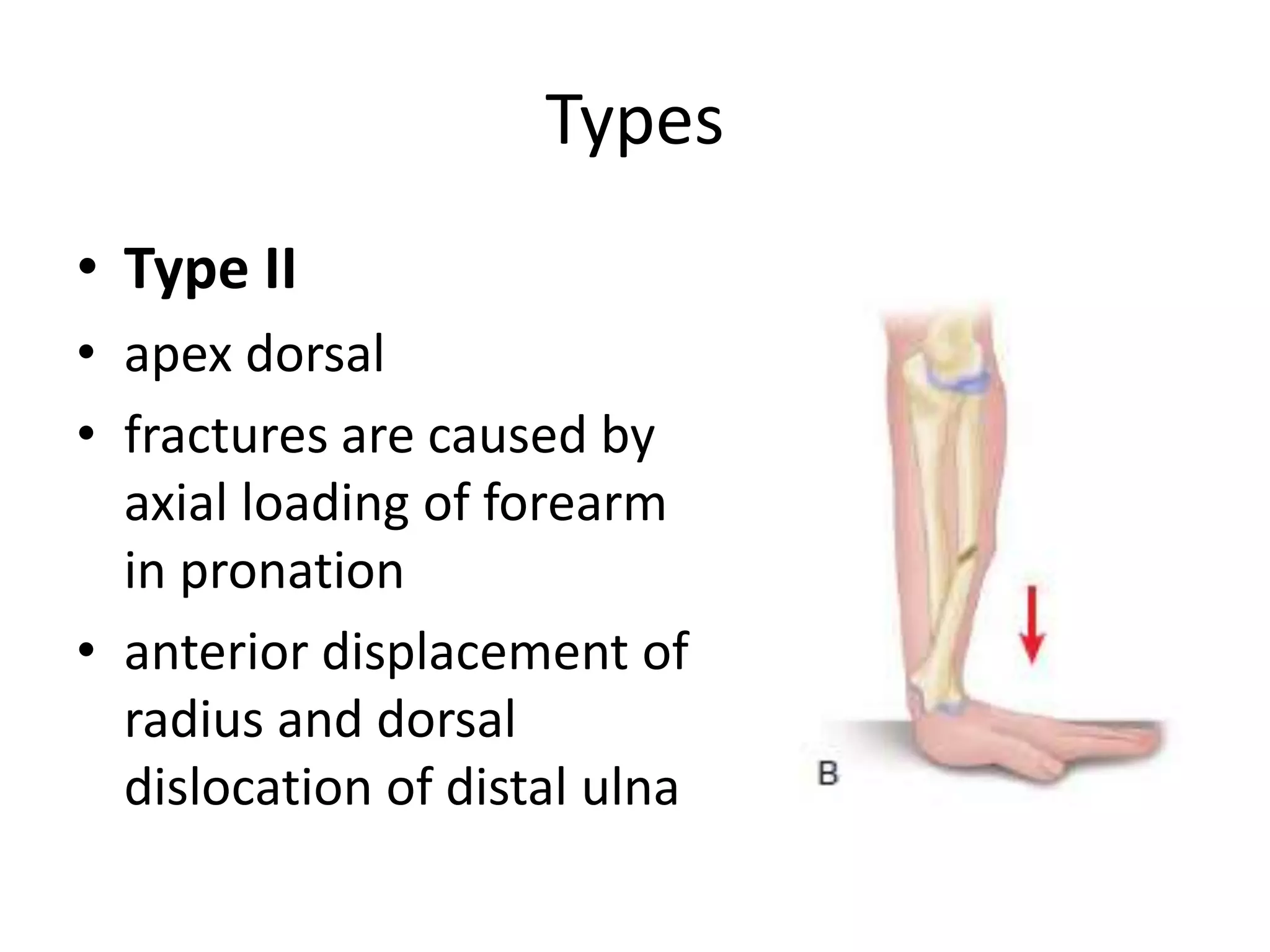 Galeazzi fracture dislocation | PPTX