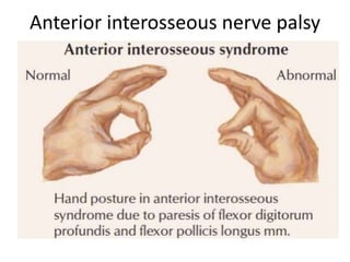 Anterior interosseous nerve palsy
 