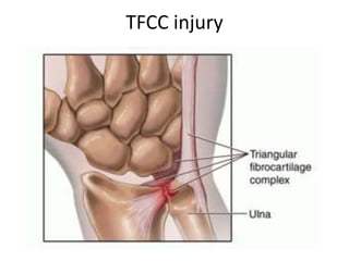 TFCC injury
 
