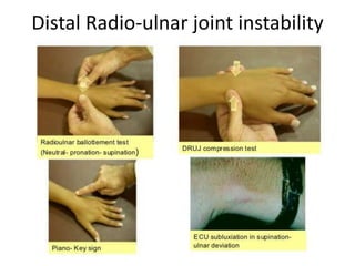 Distal Radio-ulnar joint instability
 