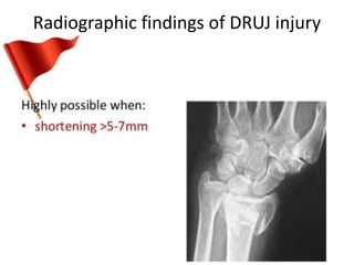 Radiographic findings of DRUJ injury
 