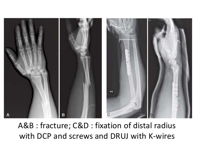 therapy galeazzi fracture therapy galeazzi fracture