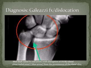 Mid-shaft radial fx (red arrow) with disruption of DURJ (distal
ulnar/radial joint) [ blue arrow] Note the prominence of the distal ulna.
 