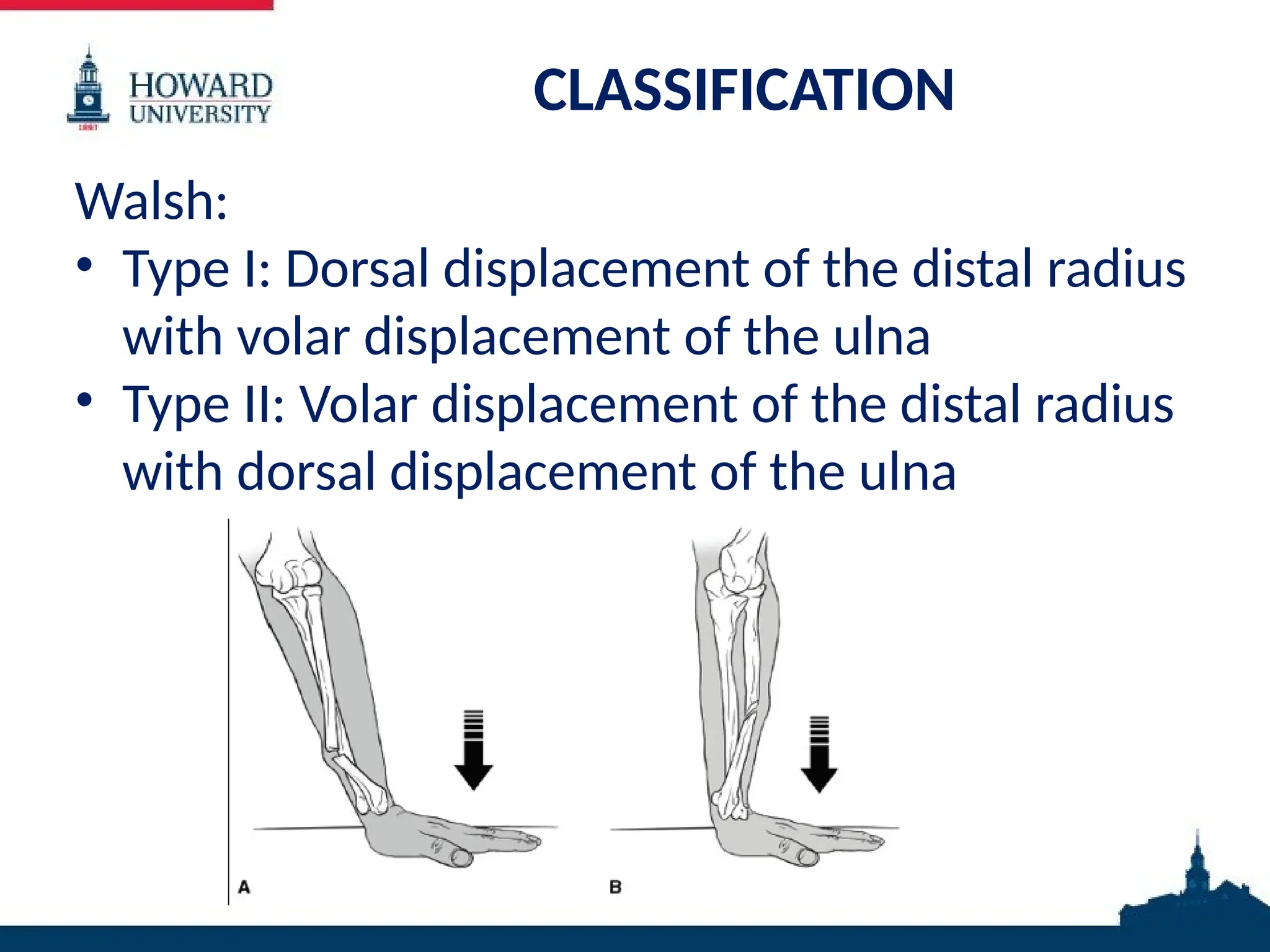 CLASSIFICATION
Walsh:
• Type I: Dorsal displacement of the distal radius
with volar displacement of the ulna
• Type II: Volar displacement of the distal radius
with dorsal displacement of the ulna
• an
 