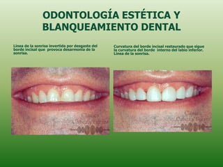 ODONTOLOGÍA ESTÉTICA Y
               BLANQUEAMIENTO DENTAL
Línea de la sonrisa invertida por desgaste del   Curvatura del borde incisal restaurado que sigue
borde incisal que provoca desarmonía de la       la curvatura del borde interno del labio inferior.
sonrisa.                                         Línea de la sonrisa.
 