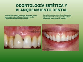 ODONTOLOGÍA ESTÉTICA Y
              BLANQUEAMIENTO DENTAL
Evaluación clínica del color, aspecto, forma,   Tamaño, forma, proporción y disposición
separación, tamaño de dientes y encía.          equilibrada en la encía y dientes antero-
Desarmonía dentaría y gingival.                 superiores. Sensación de armonía.
 