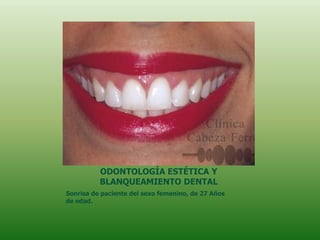 ODONTOLOGÍA ESTÉTICA Y
          BLANQUEAMIENTO DENTAL
Sonrisa de paciente del sexo femenino, de 27 Años
de edad.
 