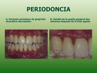 PERIODONCIA
A. Paciente portadora de gingivitis   B. Detalle de la papila gingival dos
ulcerativa necrosante.                semanas después de la fase aguda.
 