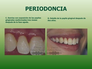 PERIODONCIA
C. Sonrisa con exposición de las papilas   D. Detalle de la papila gingival después de
gingivales neoformadas tres meses          dos años.
después de la fase aguda.
 