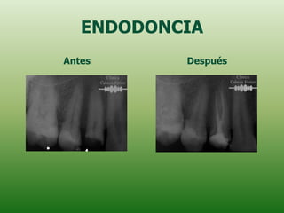 ENDODONCIA
Antes      Después
 