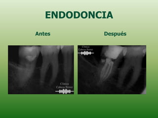 ENDODONCIA
Antes      Después
 