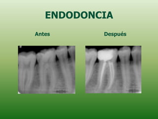 ENDODONCIA
Antes      Después
 