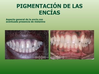PIGMENTACIÓN DE LAS
              ENCÍAS
Aspecto general de la encía con
acentuada presencia de melanina
 