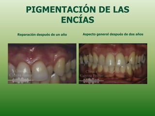 PIGMENTACIÓN DE LAS
          ENCÍAS
Reparación después de un año   Aspecto general después de dos años
 