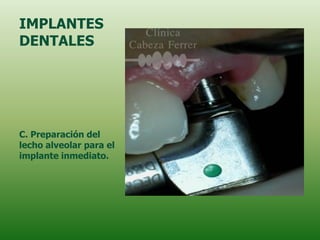 IMPLANTES
DENTALES




C. Preparación del
lecho alveolar para el
implante inmediato.
 