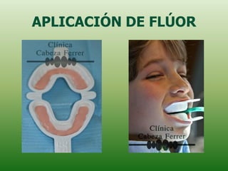 APLICACIÓN DE FLÚOR
 