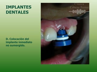 IMPLANTES
DENTALES




D. Colocación del
implante inmediato
no sumergido.
 
