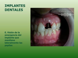IMPLANTES
DENTALES




E. Visión de la
emergencia del
implante que
mantiene
lateralmente las
papilas
 