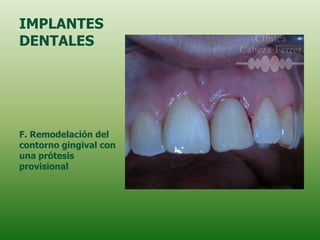 IMPLANTES
DENTALES




F. Remodelación del
contorno gingival con
una prótesis
provisional
 