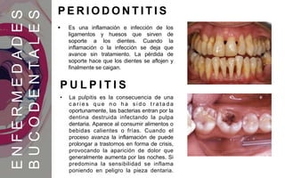  Es una inflamación e infección de los
ligamentos y huesos que sirven de
soporte a los dientes. Cuando la
inflamación o la infección se deja que
avance sin tratamiento. La pérdida de
soporte hace que los dientes se aflojen y
finalmente se caigan.
ENFERMEDADES
BUCODENTALES
P E R I O D O N T I T I S
• La pulpitis es la consecuencia de una
c a r i e s q u e n o h a s i d o t r a t a d a
oportunamente, las bacterias entran por la
dentina destruida infectando la pulpa
dentaria. Aparece al consumir alimentos o
bebidas calientes o frías. Cuando el
proceso avanza la inflamación de puede
prolongar a trastornos en forma de crisis,
provocando la aparición de dolor que
generalmente aumenta por las noches. Si
predomina la sensibilidad se inflama
poniendo en peligro la pieza dentaria.
P U L P I T I S
 