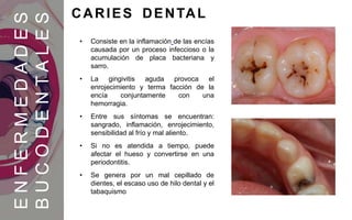 ENFERMEDADES
BUCODENTALES
CARIES DENTAL
• Consiste en la inflamación de las encías
causada por un proceso infeccioso o la
acumulación de placa bacteriana y
sarro.
• La gingivitis aguda provoca el
enrojecimiento y terma facción de la
encía conjuntamente con una
hemorragia.
• Entre sus síntomas se encuentran:
sangrado, inflamación, enrojecimiento,
sensibilidad al frío y mal aliento.
• Si no es atendida a tiempo, puede
afectar el hueso y convertirse en una
periodontitis.
• Se genera por un mal cepillado de
dientes, el escaso uso de hilo dental y el
tabaquismo
 