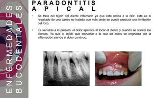 • Se trata del tejido del diente inflamado ya que este rodea a la raíz, este es el
resultado de una caries no tratada que más tarde se puede producir una limitación
del foco.
• Es sensible a la presión, el dolor aparece al tocar el diente y cuando se aprieta los
dientes. Ya que el tejido que envuelve a la raíz de estos se engruesa por la
inflamación siendo el dolor continuo.
ENFERMEDADES
BUCODENTALES
P A R A D O N T I T I S
A P I C A L
 