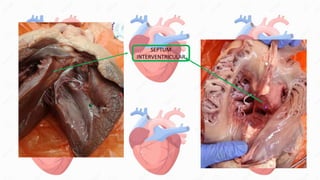 SEPTUM
INTERVENTRICULAR
 
