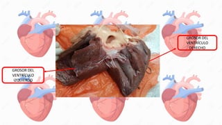 GROSOR DEL
VENTRÍCULO
DERECHO
GROSOR DEL
VENTRÍCULO
IZQUIERDO
 
