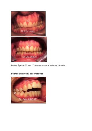 Les mini-vis en orthodontie, Dr Eric Ursat