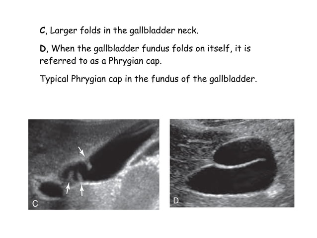 Gall Bladder Ultrasound PPT Pregnancy Reproductive Health gall-bladder-ultrasound-ppt-pregnancy-reproductive-health