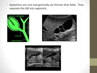 Gallbladder Segmentation Anatomy and Sonography of Gallbladder | PPTX