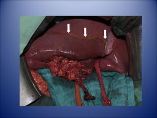 Gallbladder and extrahepatic biliary system | PPT