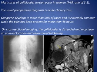 Most cases of gallbladder torsion occur in women (F/M ratio of 3:1).
The usual preoperative diagnosis is acute cholecystitis.
Gangrene develops in more than 50% of cases and is extremely common
when the pain has been present for more than 48 hours.
On cross-sectional imaging, the gallbladder is distended and may have
an unusual location and show mural thickening.
 