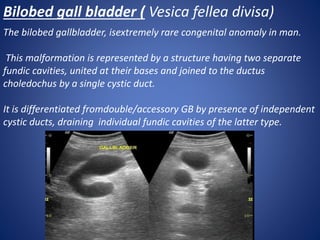 The bilobed gallbladder, isextremely rare congenital anomaly in man.
This malformation is represented by a structure having two separate
fundic cavities, united at their bases and joined to the ductus
choledochus by a single cystic duct.
It is differentiated fromdouble/accessory GB by presence of independent
cystic ducts, draining individual fundic cavities of the latter type.
Bilobed gall bladder ( Vesica fellea divisa)
 