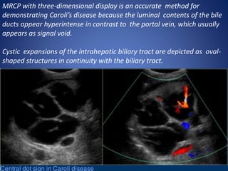MRCP with three-dimensional display is an accurate method for
demonstrating Caroli’s disease because the luminal contents of the bile
ducts appear hyperintense in contrast to the portal vein, which usually
appears as signal void.
Cystic expansions of the intrahepatic biliary tract are depicted as oval-
shaped structures in continuity with the biliary tract.
 