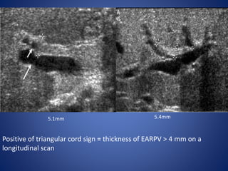 Positive of triangular cord sign = thickness of EARPV > 4 mm on a
longitudinal scan
5.1mm 5.4mm
 