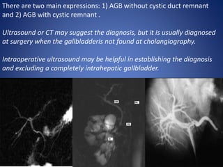 There are two main expressions: 1) AGB without cystic duct remnant
and 2) AGB with cystic remnant .
Ultrasound or CT may suggest the diagnosis, but it is usually diagnosed
at surgery when the gallbladderis not found at cholangiography.
Intraoperative ultrasound may be helpful in establishing the diagnosis
and excluding a completely intrahepatic gallbladder.
 