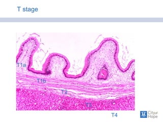 T1a
T1b
T2
T3
T4
T stage
 
