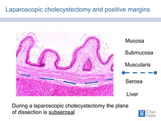 Laparoscopic cholecystectomy and positive margins
Mucosa
Submucosa
Muscularis
Serosa
Liver
During a laparoscopic cholecystectomy the plane
of dissection is subserosal
 