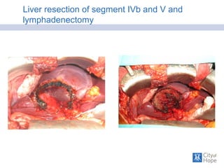 Liver resection of segment IVb and V and
lymphadenectomy
 