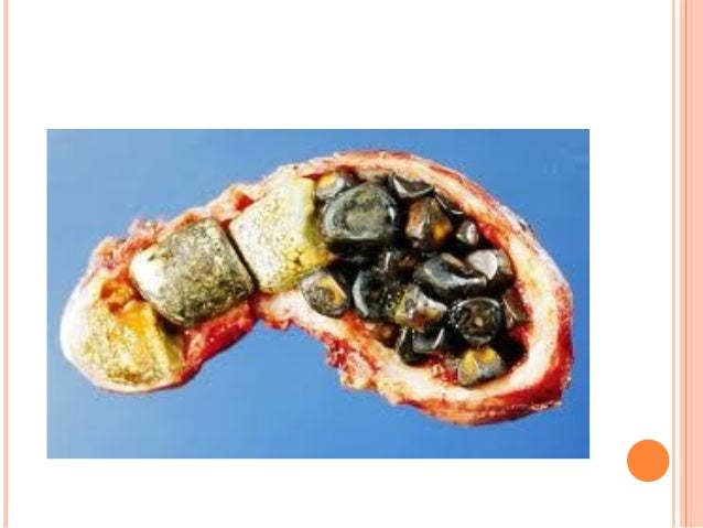 Gall bladder cancer
